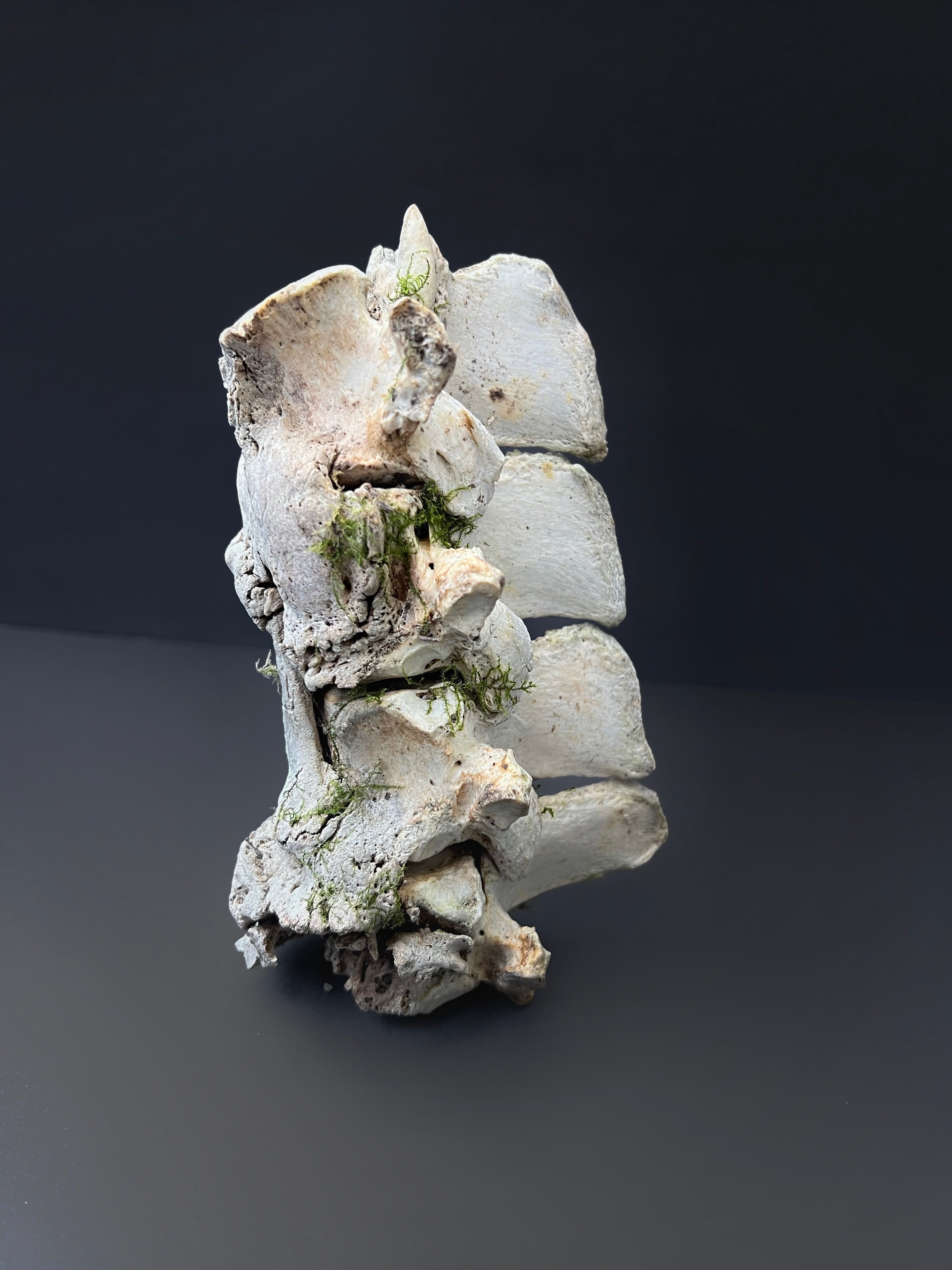 Arthritic Fusion of Spine - Natural Bone Specimen